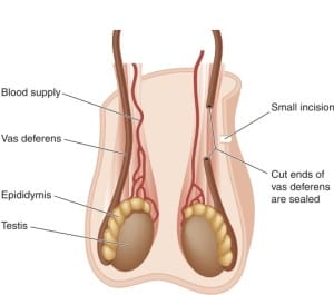 illustartion of vasectomy in chattanooga TN