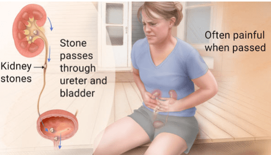 woman holding stomach in pain