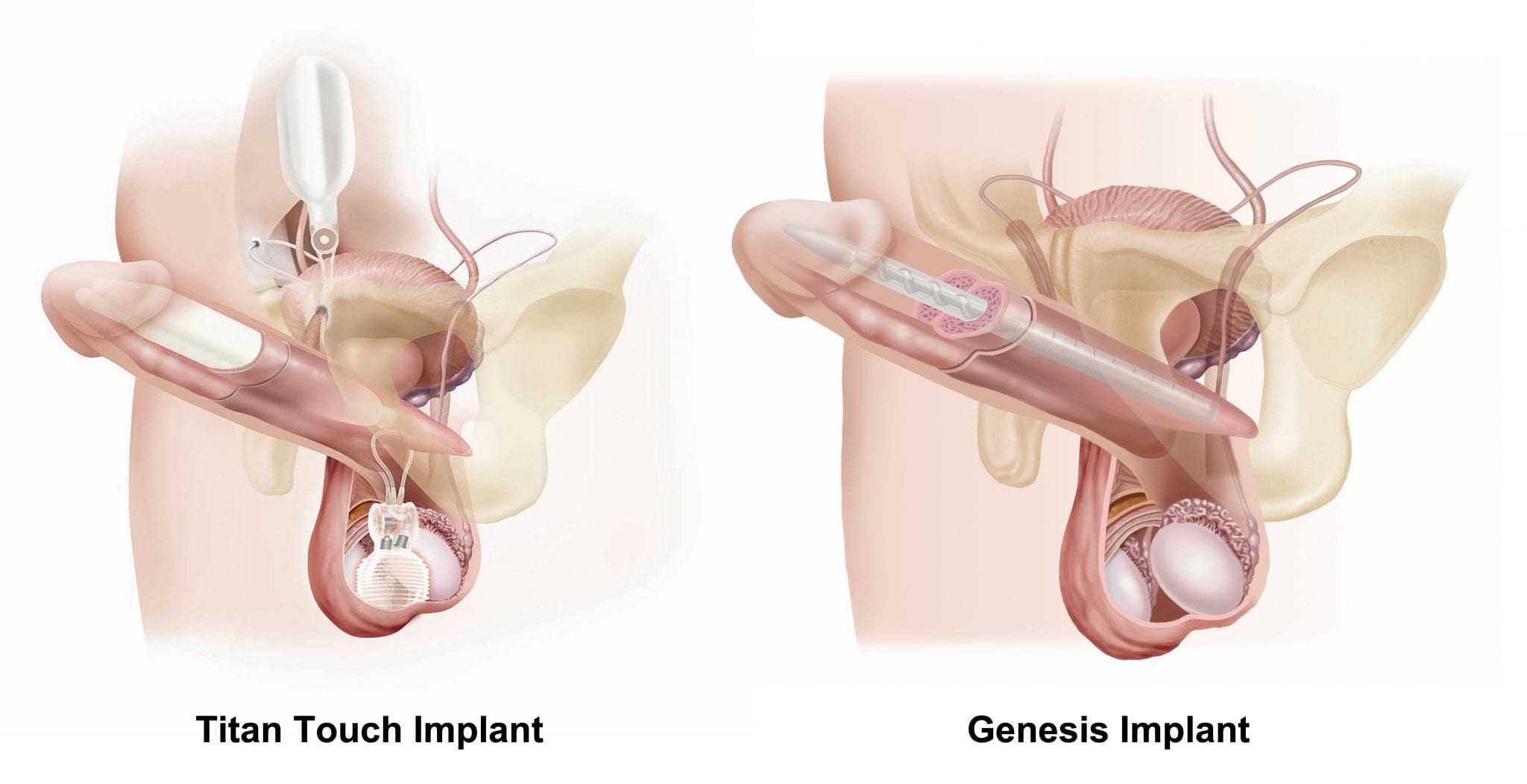 Tiatan Touch Penile Implant and Genesis Implant Illustration 