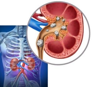 Diagram shows kidney stone deposits in the kidneys and urinary tract. Removal can help to diminish discomfort