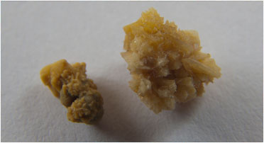 kidney stone chattanooga