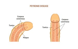 peyronie's disease chattanooga, tn
