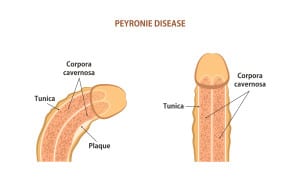 Peyronie’s Disease Treatment Chattanooga TN 