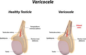 varicocele in TN 