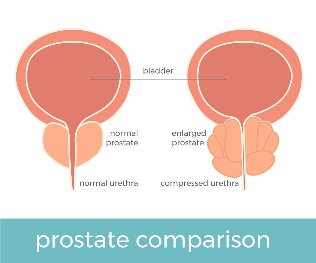What causes the prostate to become enlarged