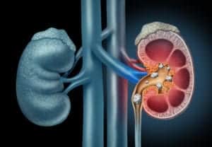 illustration of two kidneys, one of which has a cross section view of stones inside
