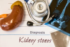 Kidney Stones Chattanooga, TN