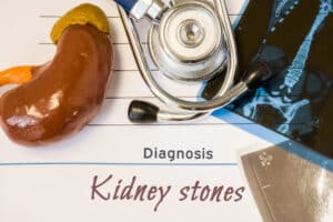 A stethoscope, a model of a kidney, and a paper that says “Diagnosis: Kidney Stones”